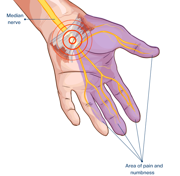 hand showing median nerve and carpal tunnel syndrome symptoms