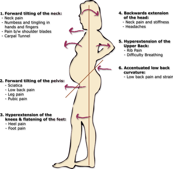 Image of pregnant woman spine and pelvis alignment during pregnancy and how Webster technique can help for breech baby