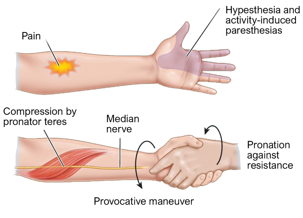 diagram pronator teres syndrome and median nerve entrapment and symptoms